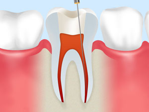 ②虫歯と神経の除去